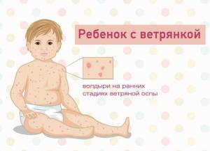 Фото Как начинается и развивается ветрянка