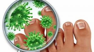 Фото Причины, симптомы и лечение грибковой инфекции